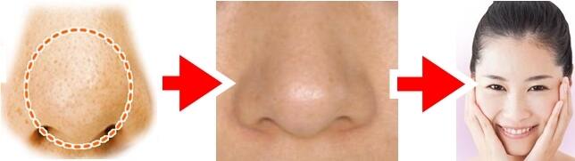 鼻の黒ずみをとる簡単な方法