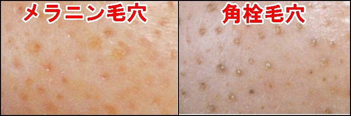 鼻の黒ずみをとる簡単な方法