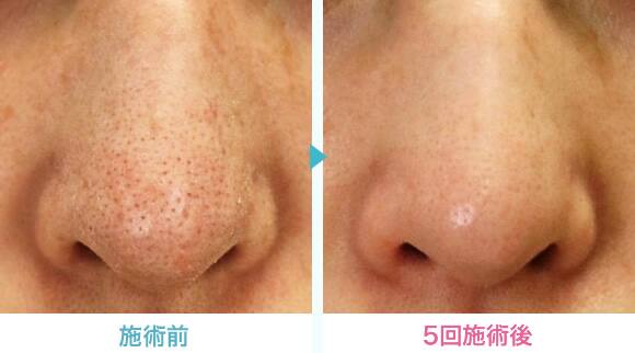 ウルトラ美白レーザー口コミ